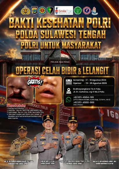 Polri Gelar Operasi Celah Bibir dan Lelangit Gratis di Palu, Screening Dibuka 17–18 Agustus